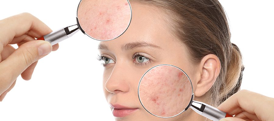 acne scar treatment dubai