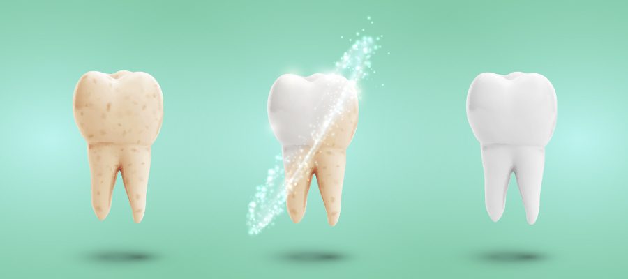 internal tooth bleaching dubai