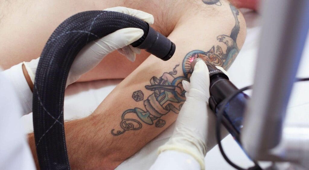 Tattoo Removal Dubai