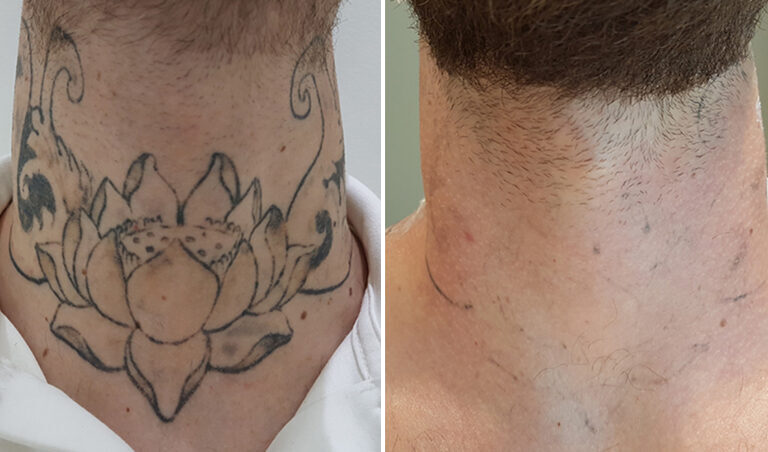 Tattoo Removal Using Picosecond Technology at Medical Village in Dubai