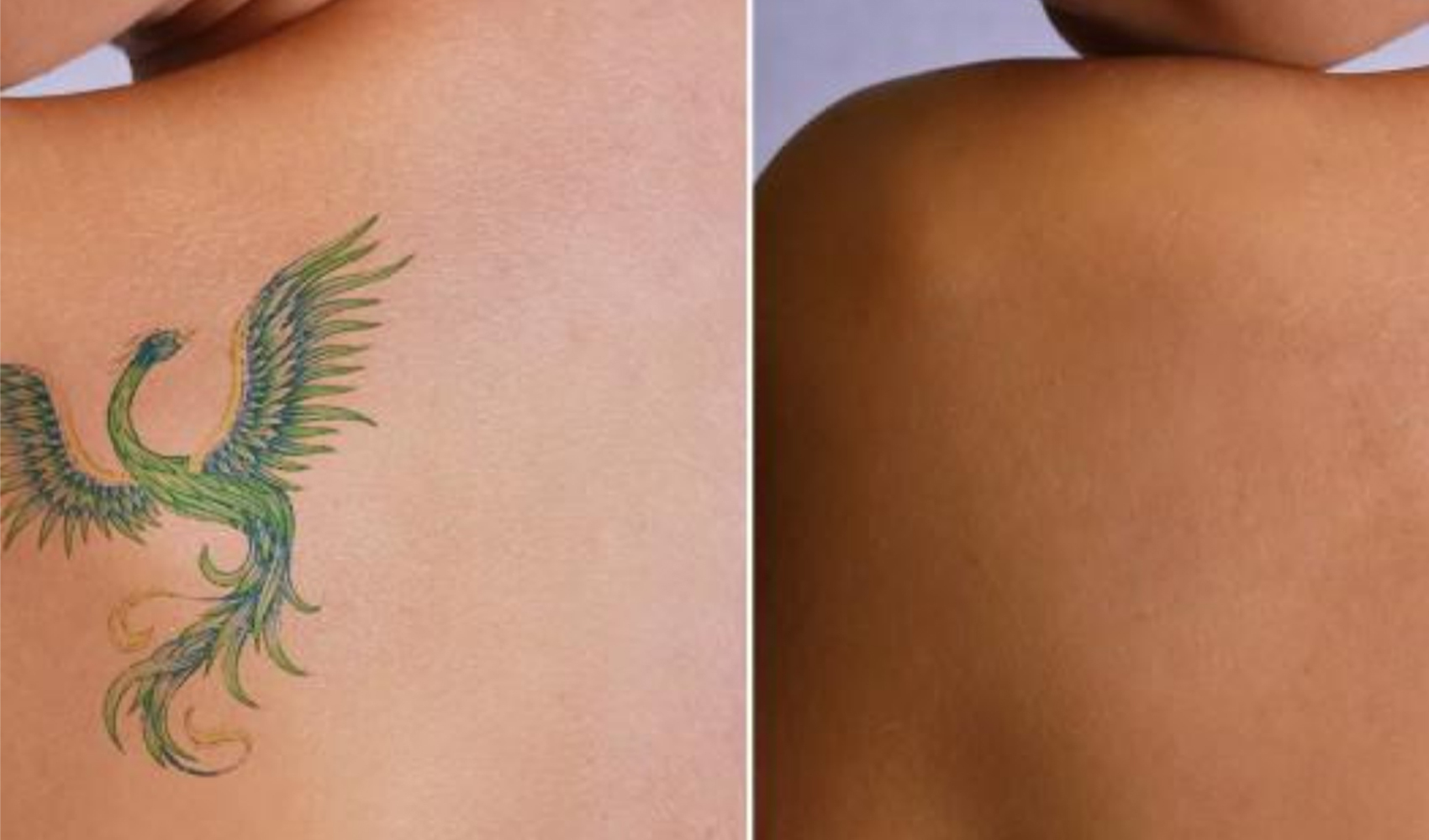 Picosure Laser Tattoo Removal Treatment and Skin Rejuvenation Toronto