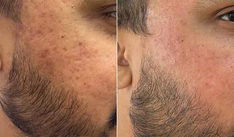 Acne Scars before and after