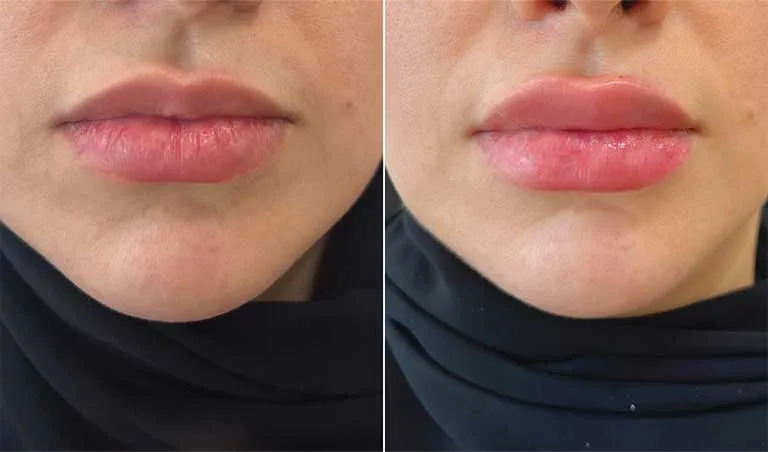 Lip Fillers before and after