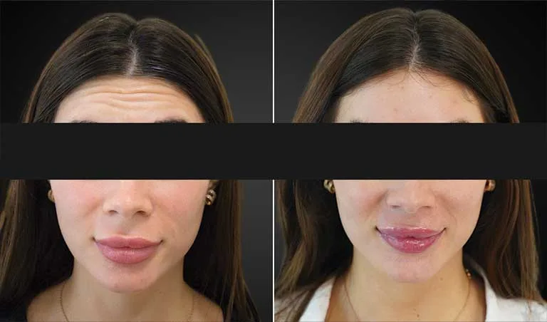 Lip Fillers before and after