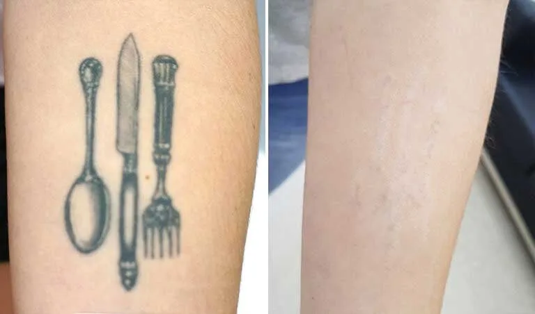 Tattoo Removal before and after