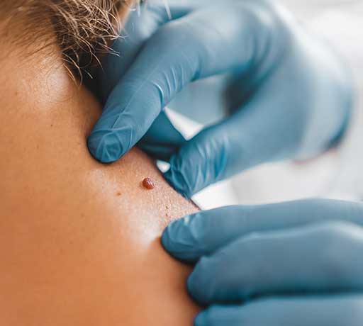 Best Mole Removal Treatment in Dubai – Medical Village