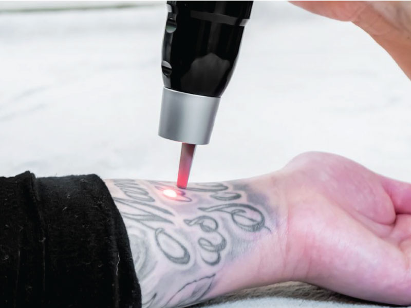 removing tattoo using picosure