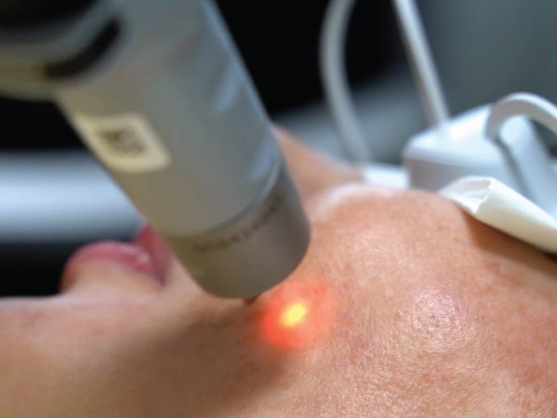 Melasma Treatment Using Picosure Pro