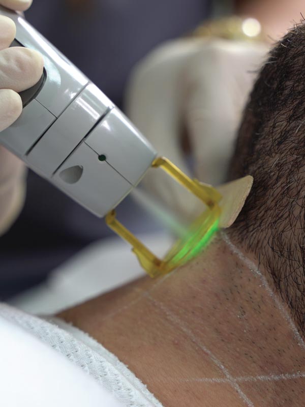 Candela-Handpiece-Mustache