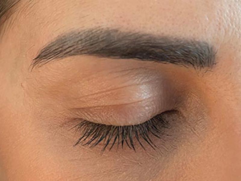 Eyebrow-Tattoo-Removal