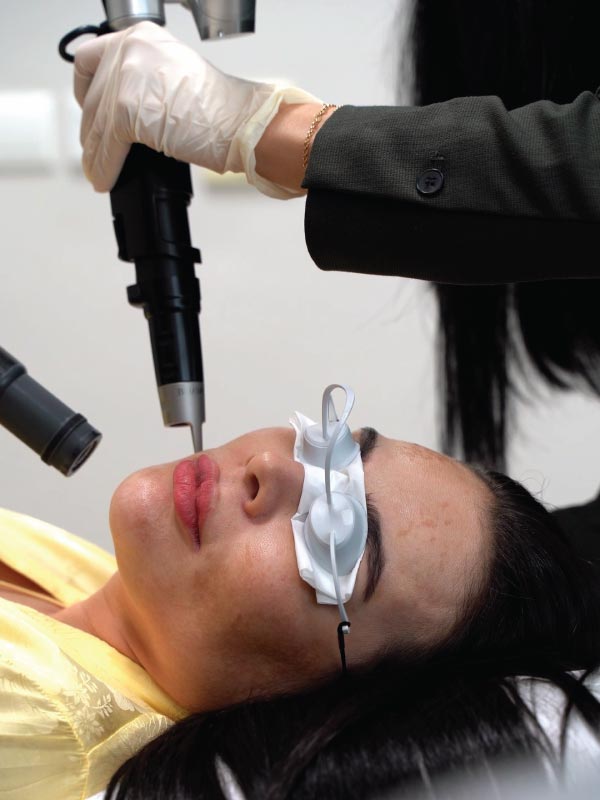 Melasma-treatment-using-picosure