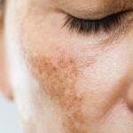 Get Rid Hyperpigmentation