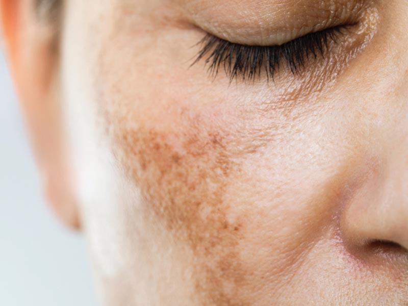 Get Rid Hyperpigmentation