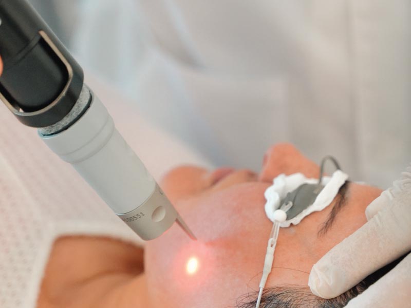 Laser Treatments for Stubborn Sun Damage