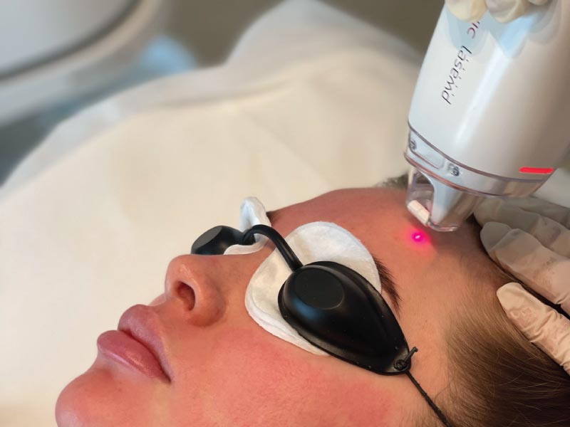 Tightening Loose Skin Using LaseMD