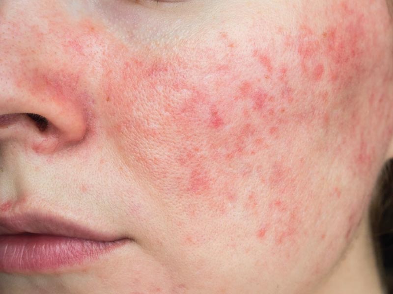 Treatments for Stubborn Rosacea