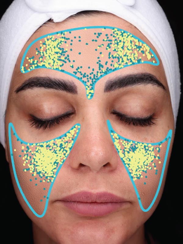 Visia Skin Analysis