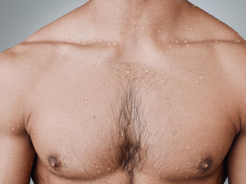 Laesr Hair Removal Chest